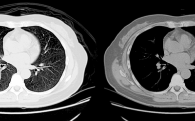 Cyanotic Congenital Heart Disease: A Radiologist’s Guide