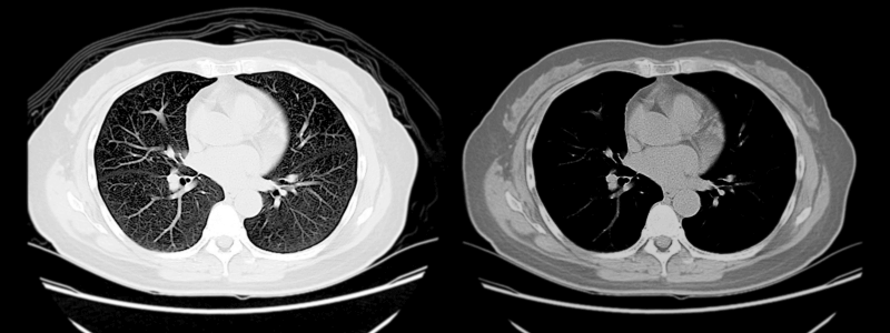 Cyanotic Congenital Heart Disease: A Radiologist’s Guide