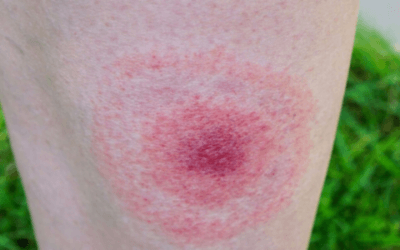 A 67-Year-Old Woman With a Rash on Her Forearm