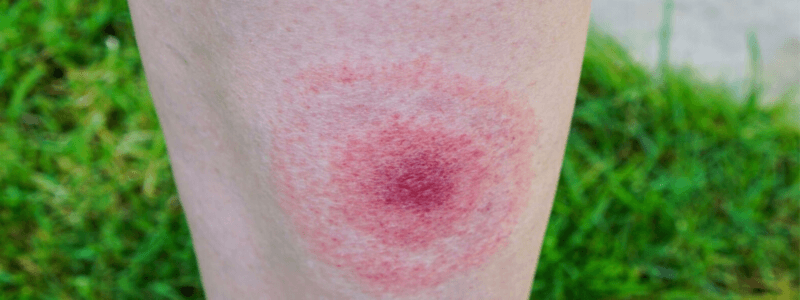 A 67-Year-Old Woman With a Rash on Her Forearm